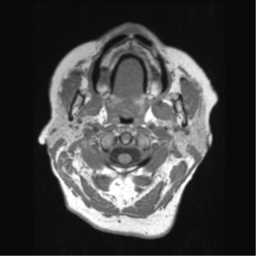 Anaplastic astrocytoma IDH wild-type (pseudoprogression) (Radiopaedia 42209-45276 Axial T1 6).png