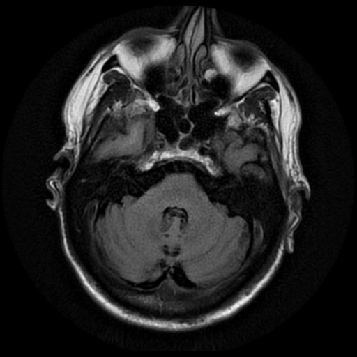 File:Anaplastic meningioma with recurrence (Radiopaedia 34452-35790 Axial T2 FLAIR 5).png