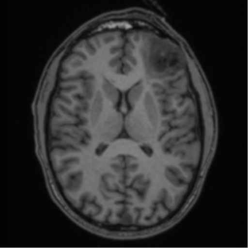 Anaplastic oligodendroglioma with skull fracture (Radiopaedia 74831-85845 Axial T1 35).png