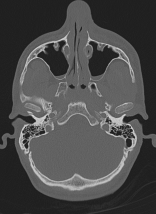 Anaplastic oligodendroglioma with skull fracture (Radiopaedia 74831-85846 Axial bone window 66).png