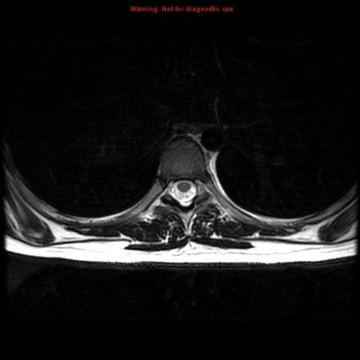 File:Aneurysmal bone cyst (Radiopaedia 9419-10103 Axial T2 2).jpg