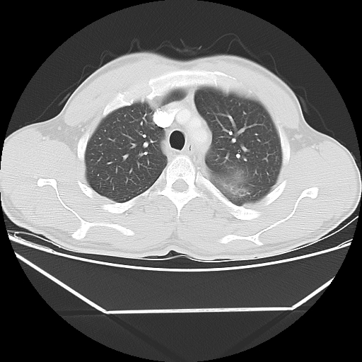 File:Aneurysmal bone cyst - rib (Radiopaedia 82167-96220 Axial lung window 23).jpg