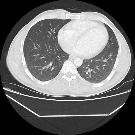 File:Aneurysmal bone cyst - rib (Radiopaedia 82167-96220 Axial lung window 44).jpg