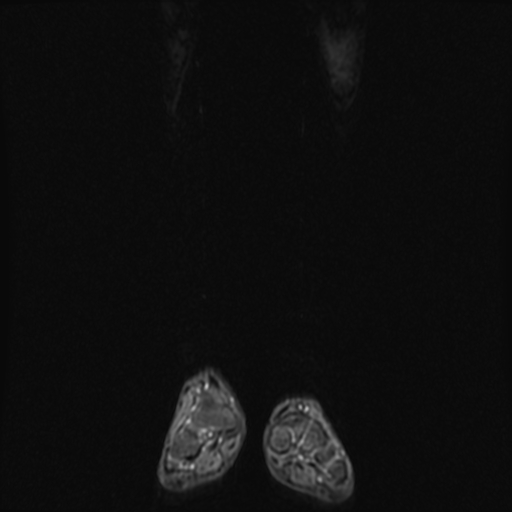 File:Aneurysmal bone cyst - tibia (Radiopaedia 22343-22367 Coronal STIR 1).jpg