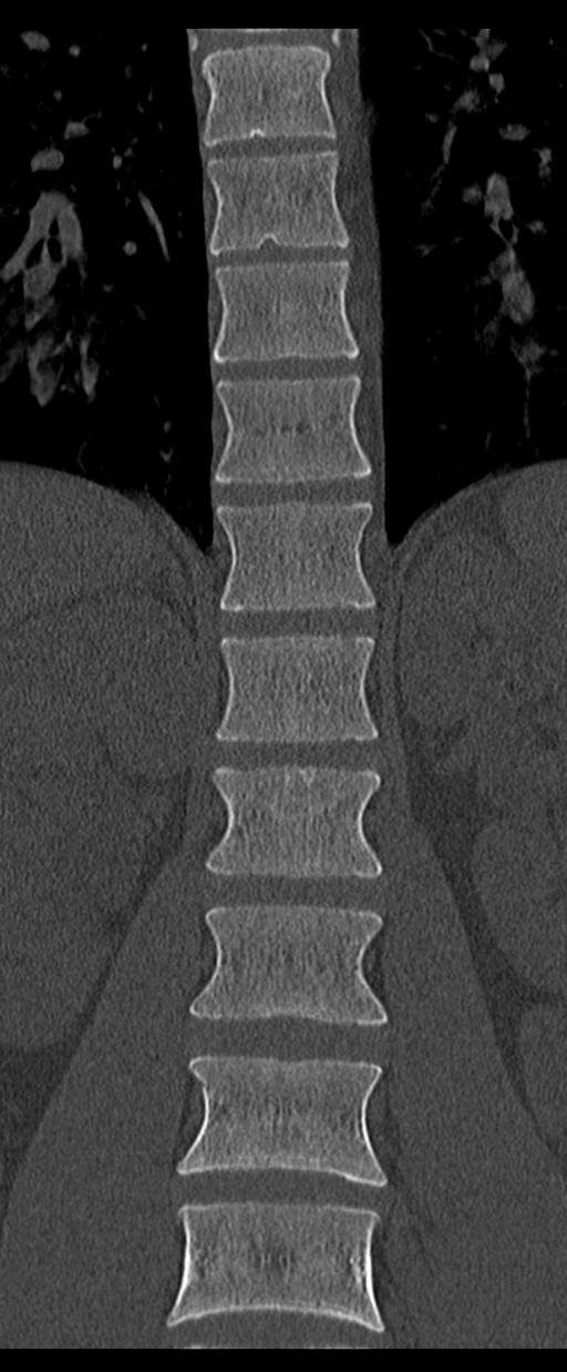 Aneurysmal bone cyst T11 (Radiopaedia 29294-29721 Coronal bone window 25).jpg