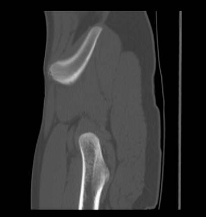 Aneurysmal bone cyst of ischium (Radiopaedia 25957-26094 Sagittal bone window 63).png