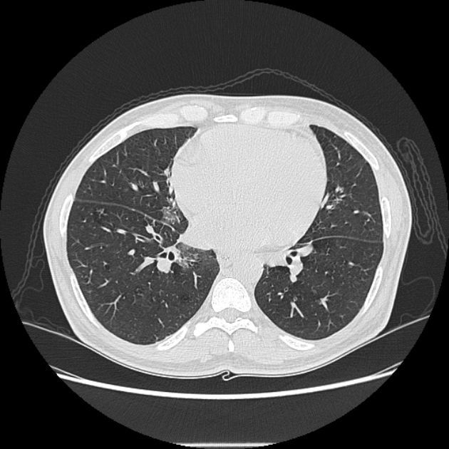 Angioinvasive aspergellosis (Radiopaedia 66995-76315 Axial lung window 31).jpg