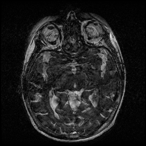 Angioinvasive aspergillosis in the pituitary fossa (Radiopaedia 39676-42010 Ax 3D FIESTA VOLUME 81).png