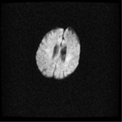 Angioinvasive aspergillosis in the pituitary fossa (Radiopaedia 39676-42010 Axial DWI 27).png