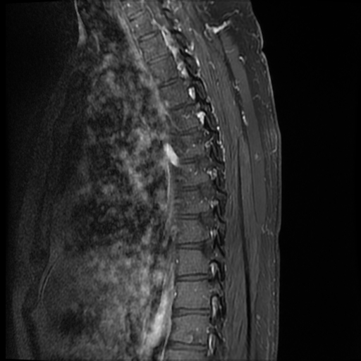 File:Angiolipoma - thoracic spine (Radiopaedia 28242-28479 E 5).jpg