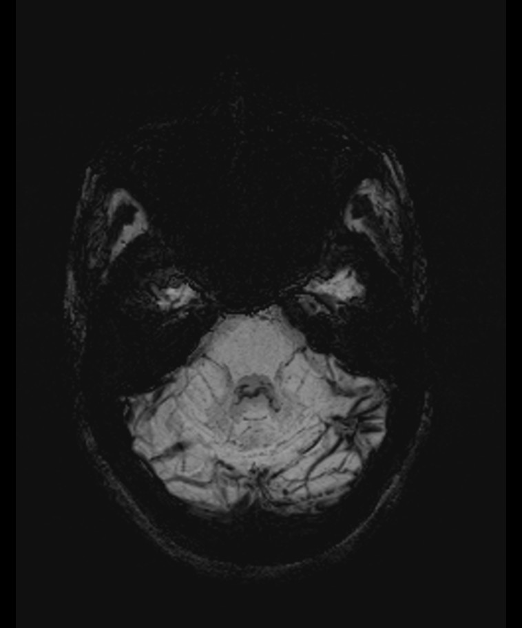 Angiomatous meningioma (Radiopaedia 79459-92579 E 15).jpg