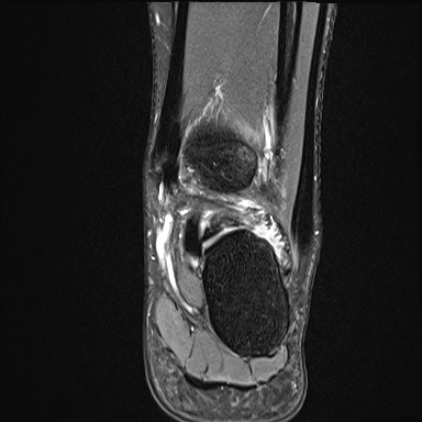 Ankle syndesmotic injury (Radiopaedia 69066-78837 Coronal PD fat sat 21).jpg
