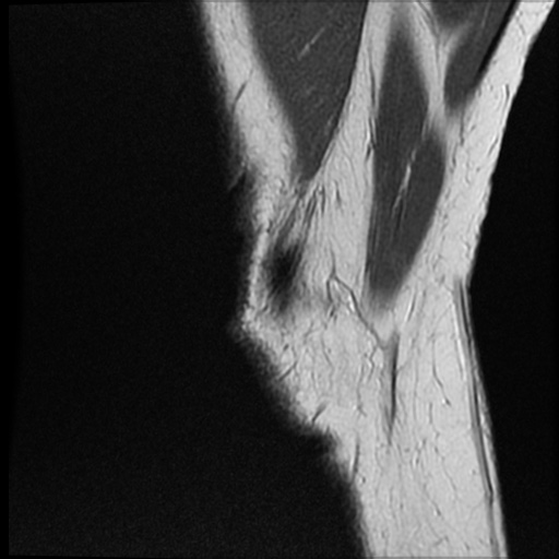 Anomalous insertion of the medial meniscus (Radiopaedia 77559-89721 Sagittal PD 49).jpg