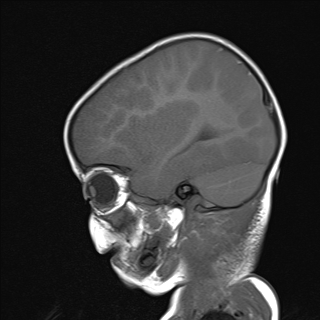 File:Anoxic brain injury (Radiopaedia 79165-92139 Sagittal T1 7).jpg
