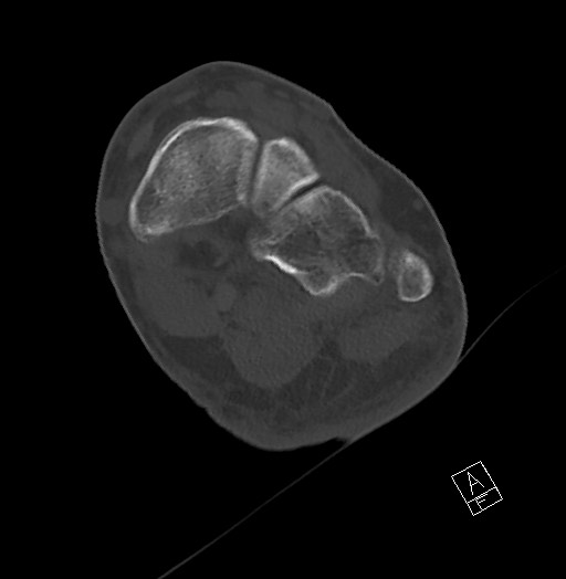Anterior calcaneal process fracture (Radiopaedia 63353-71943 Axial bone window 84).jpg