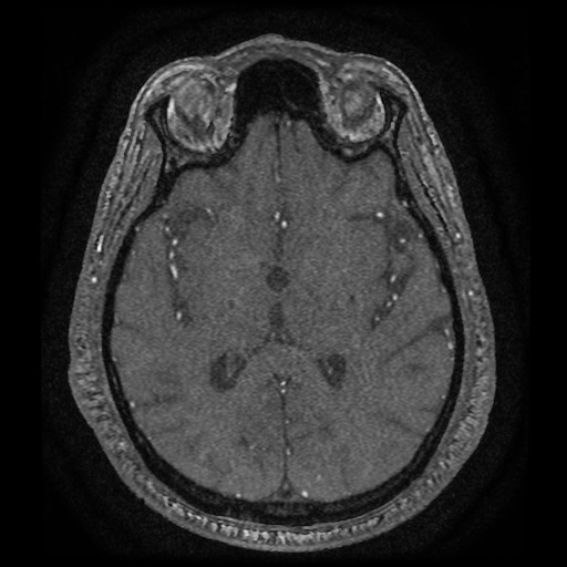 Anterior cerebral artery infarction (Radiopaedia 46794-51323 Axial MRA 111).jpg