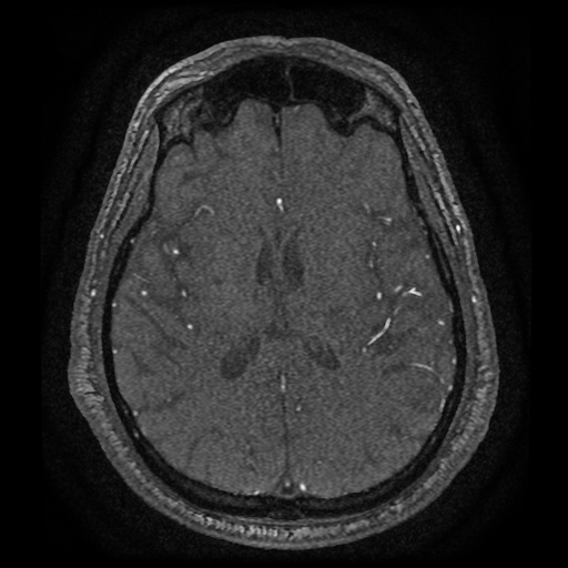 Anterior cerebral artery infarction (Radiopaedia 46794-51323 Axial MRA 124).jpg
