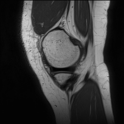 Anterior cruciate ligament rupture and posteromedial corner injury (Radiopaedia 67338-76723 Sagittal PD 36).jpg