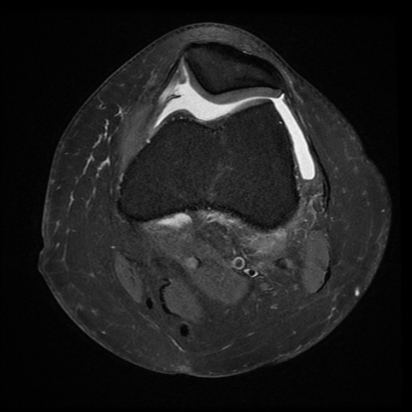 File:Anterior cruciate ligament tear, Wrisberg rip and bucket-handle tear of medial meniscus (Radiopaedia 75872-87266 Axial PD fat sat 20).jpg
