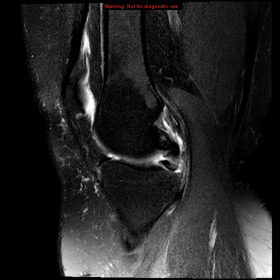File:Anterior cruciate ligament tear (Radiopaedia 12329-12612 E 14).jpg