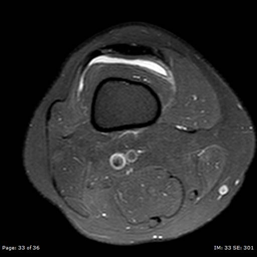 File:Anterior cruciate ligament tear (Radiopaedia 70783-80964 Axial PD fat sat 33).jpg