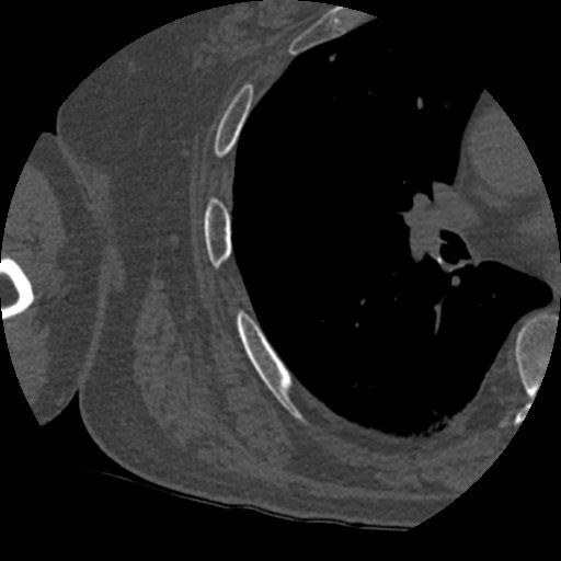 Anterior glenohumeral dislocation with Hill-Sachs lesion (Radiopaedia 62877-71249 Axial bone window 99).jpg
