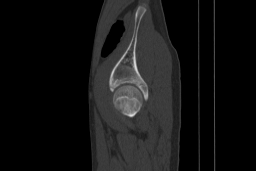 Anterior inferior iliac spine avulsion injury (Radiopaedia 88666-105376 Sagittal bone window 77).jpg
