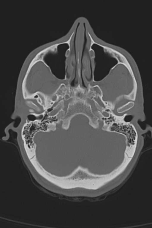 Anterior nasal spine fracture (Radiopaedia 46138-50494 Axial bone window 46).png