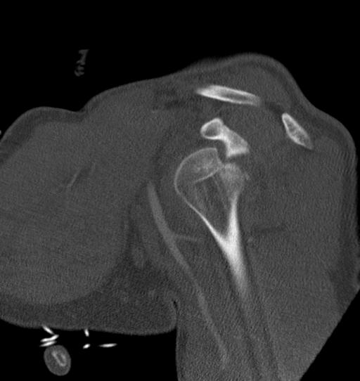 Anterior shoulder dislocation with Hill-Sachs and bony Bankart lesions (Radiopaedia 40424-42974 Sagittal bone window 24).png