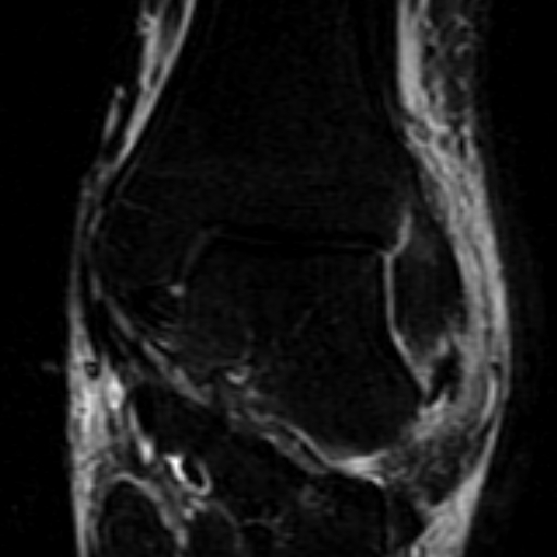 File:Anterior talofibular ligament rupture (Radiopaedia 15831-15484 Coronal STIR 11).jpg