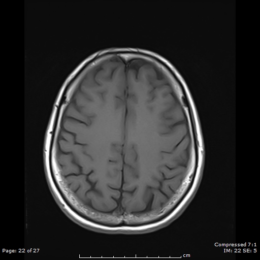 File:Anterior temporal lobe perivascular space (Radiopaedia 88283-104914 Axial T1 22).jpg