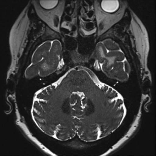 Anterior temporal pole cysts (Radiopaedia 46629-51102 Axial T2 39).png