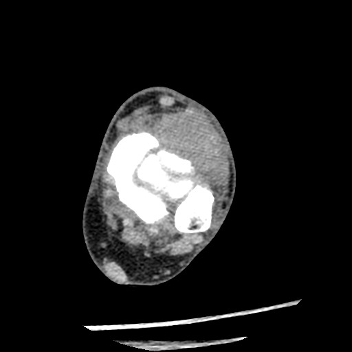 Anterior tibial artery false aneurysm (Radiopaedia 88984-105809 A 115).jpg