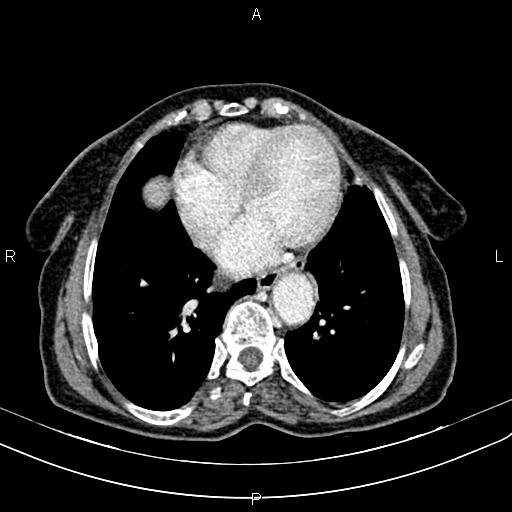 File:Aortic aneurysm and Lemmel syndrome (Radiopaedia 86499-102554 A 5).jpg