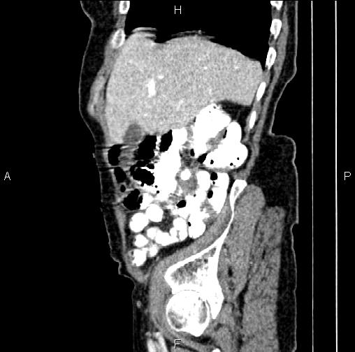 File:Aortic aneurysm and Lemmel syndrome (Radiopaedia 86499-102554 D 16).jpg