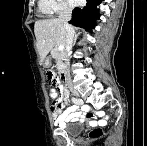 Aortic aneurysm and Lemmel syndrome (Radiopaedia 86499-102554 D 38).jpg