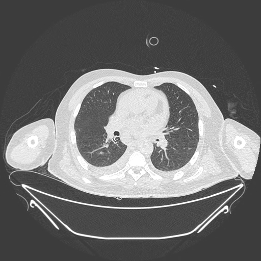 Aortic arch aneurysm (Radiopaedia 84109-99365 Axial lung window 144).jpg
