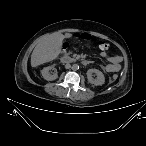 Aortic arch aneurysm (Radiopaedia 84109-99365 Axial non-contrast 347).jpg