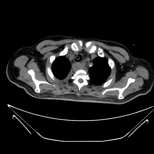 Aortic arch aneurysm (Radiopaedia 84109-99365 Axial non-contrast 47).jpg