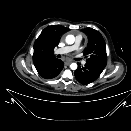File:Aortic arch aneurysm (Radiopaedia 84109-99365 C 201).jpg