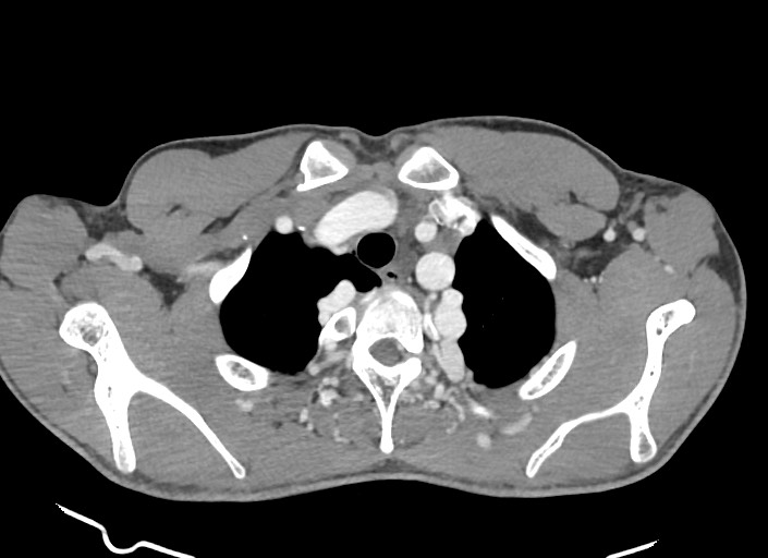 File:Aortic coarctation with aneurysm (Radiopaedia 74818-85828 A 168).jpg