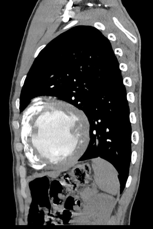 Aortic coarctation with aneurysm (Radiopaedia 74818-85828 B 124).jpg