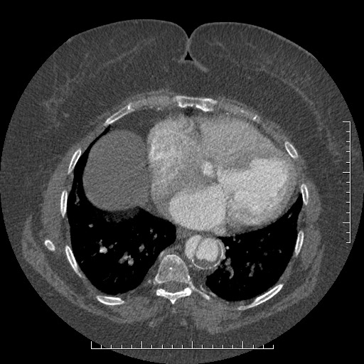 Aortic dissection- Stanford A (Radiopaedia 35729-37268 A 68).jpg