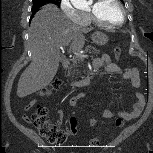 Aortic dissection- Stanford A (Radiopaedia 35729-37268 F 48).jpg