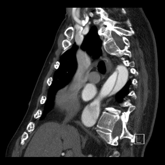 Aortic dissection (CTPA) (Radiopaedia 75506-86750 C 47).jpg