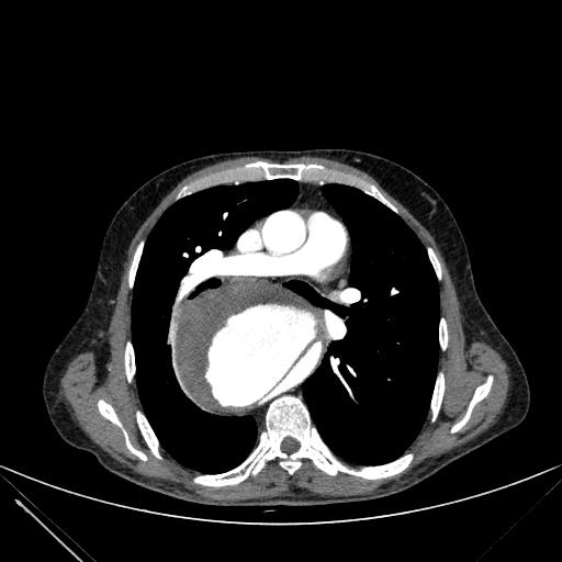 Aortic dissection (Radiopaedia 27466-27665 C+ arterial phase 115).jpg
