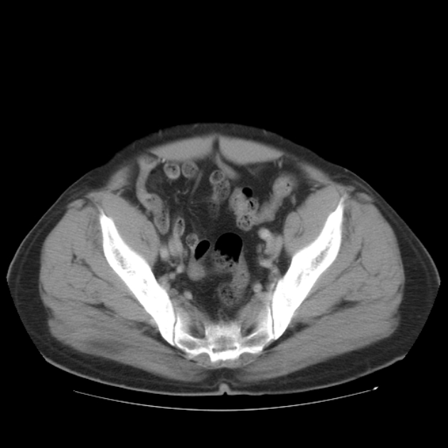 Aortic dissection (Radiopaedia 44411-48061 C 97).jpg