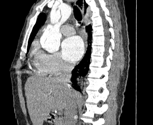 File:Aortic dissection - Stanford A -DeBakey I (Radiopaedia 28339-28587 C 19).jpg