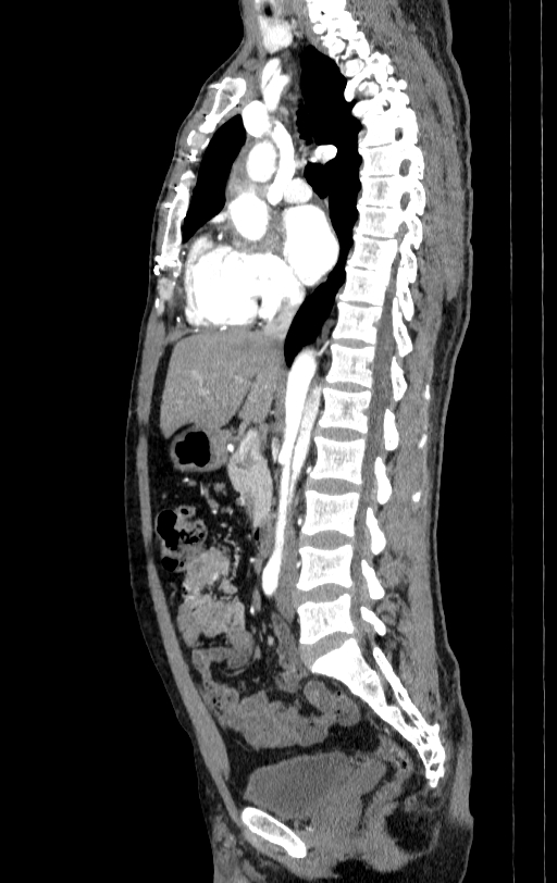 Aortic dissection - Stanford type A (Radiopaedia 83418-98500 B 27).jpg