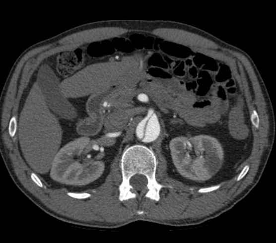 File:Aortic dissection - Stanford type B (Radiopaedia 73648-84437 A 138).jpg